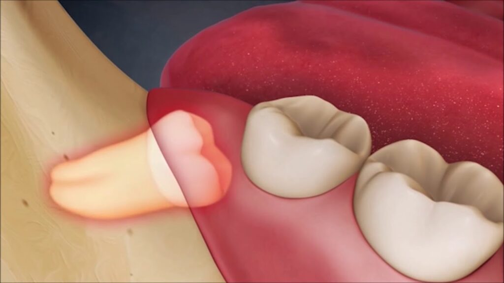 Răng khôn mọc lệch gây ra biến chứng gì và cách xử lý như thế nào?