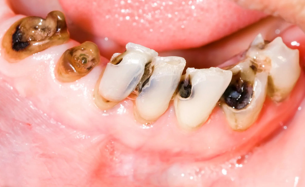 Sâu răng: Nguyên nhân, triệu chứng và cách điều trị