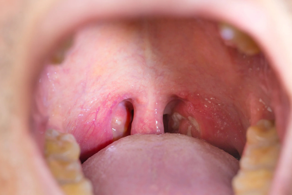 Sỏi amidan là gì? Nguyên nhân, triệu chứng, cách trị