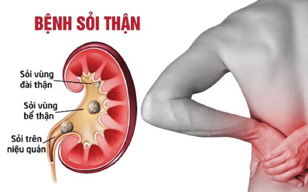 Sỏi thận: Nguyên nhân, dấu hiệu, cách chẩn đoán và điều trị