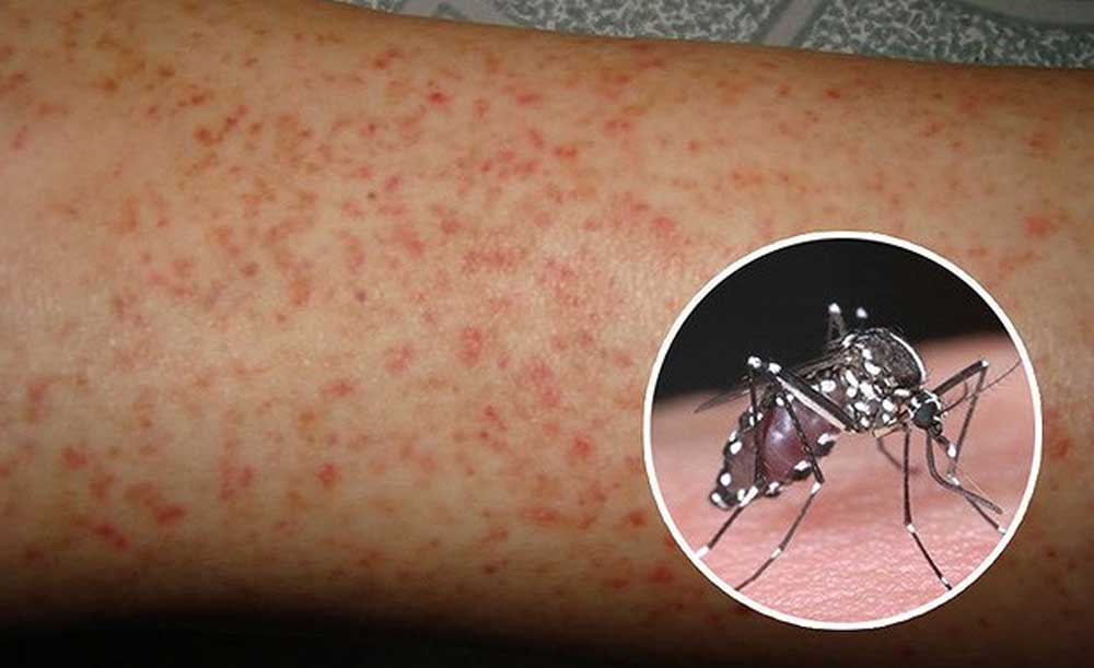 Sốt xuất huyết Dengue là gì? Nguyên nhân và cách điều trị