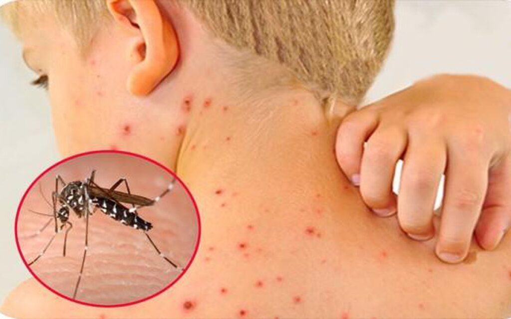 Lý giải nguyên nhân sốt xuất huyết vì sao khỏe rồi tử vong?