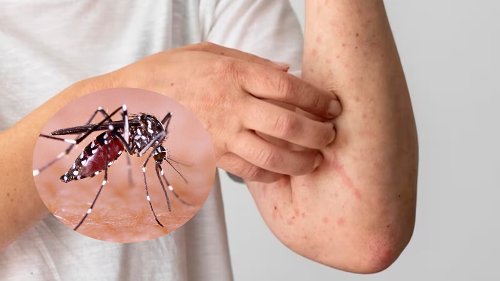 Tác nhân gây ra bệnh sốt xuất huyết là gì? Triệu chứng & phòng ngừa
