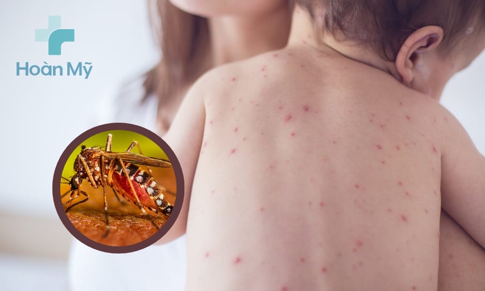Triệu chứng sốt xuất huyết ở trẻ em