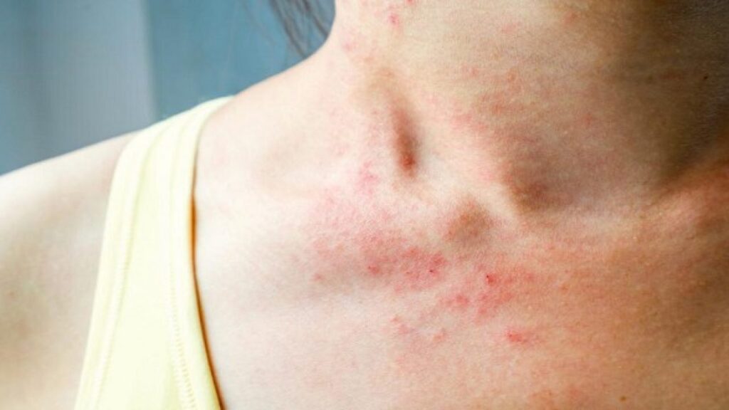 Hiện tượng phát ban có thể là tác dụng phụ của thuốc ngủ