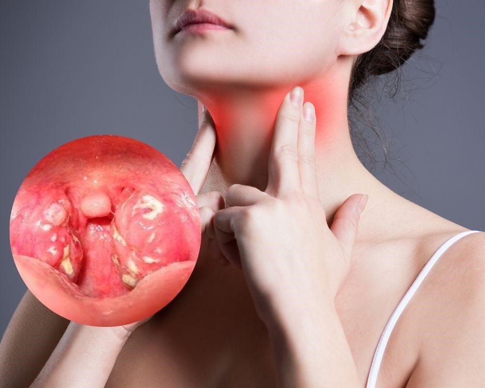 Nhiều tác nhân gây ra đau họng