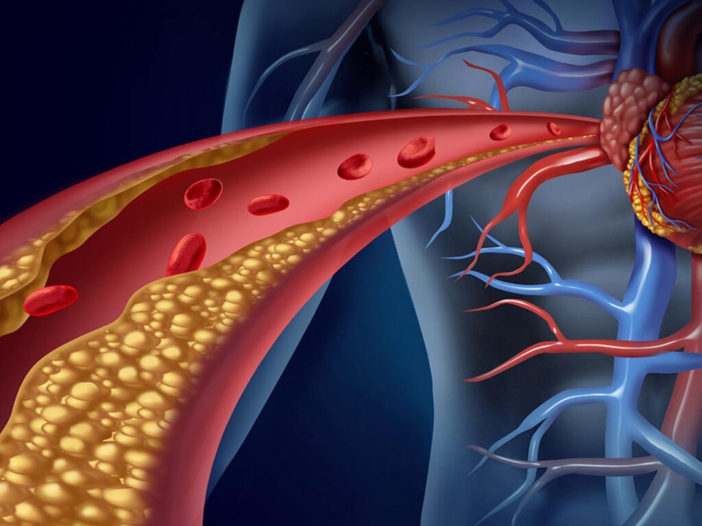 Tăng cholesterol 