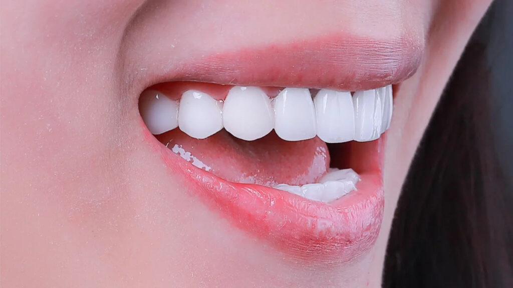 Tẩy trắng răng là gì? Cần lưu ý gì khi thực hiện?