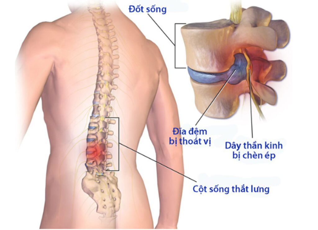 Thoái hóa cột sống: Nguyên nhân, chẩn đoán và cách điều trị