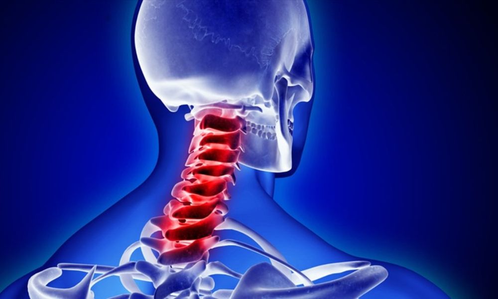 Thoái hóa đốt sống cổ: Nguyên nhân, triệu chứng, chẩn đoán và điều trị