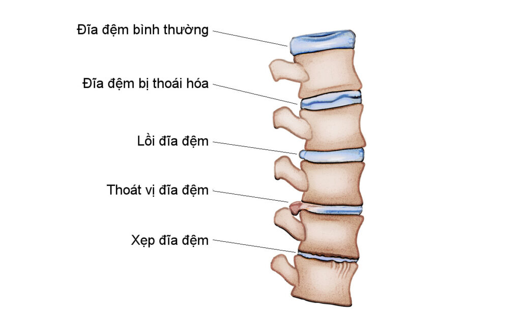 Thoái vị đĩa đệm cột sống