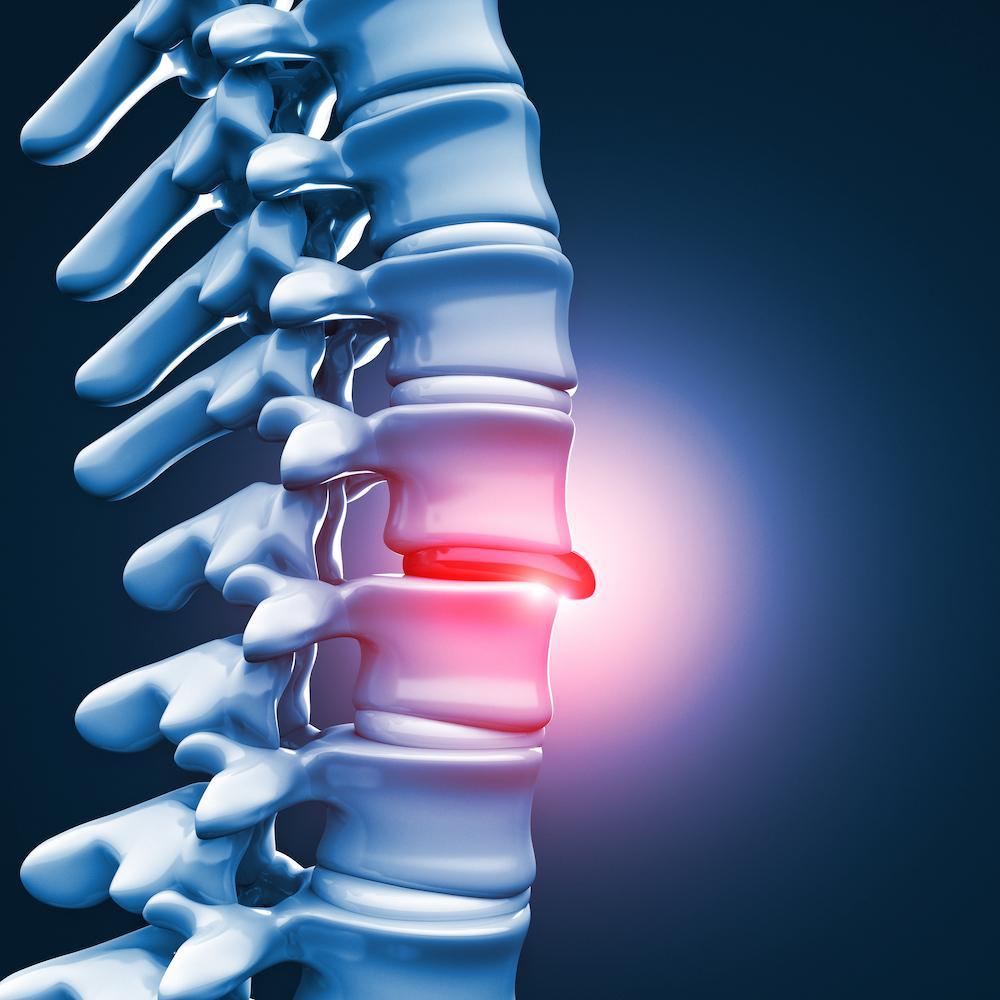 Thoát vị đĩa đệm là gì? Nguyên nhân, triệu chứng & cách điều trị