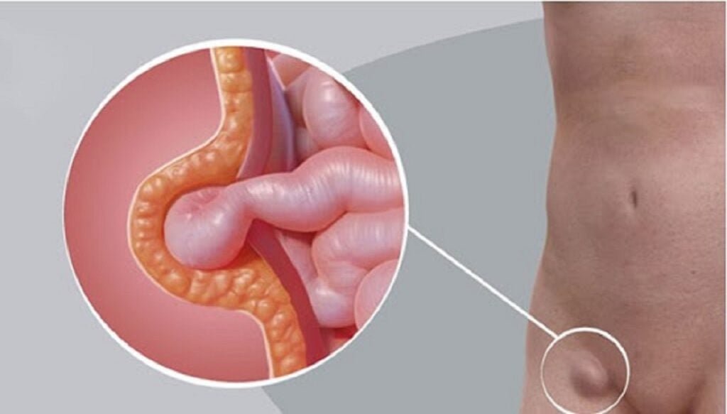 Thoát vị bẹn có nguy cơ tử vong cao nếu không được điều trị kịp thời 