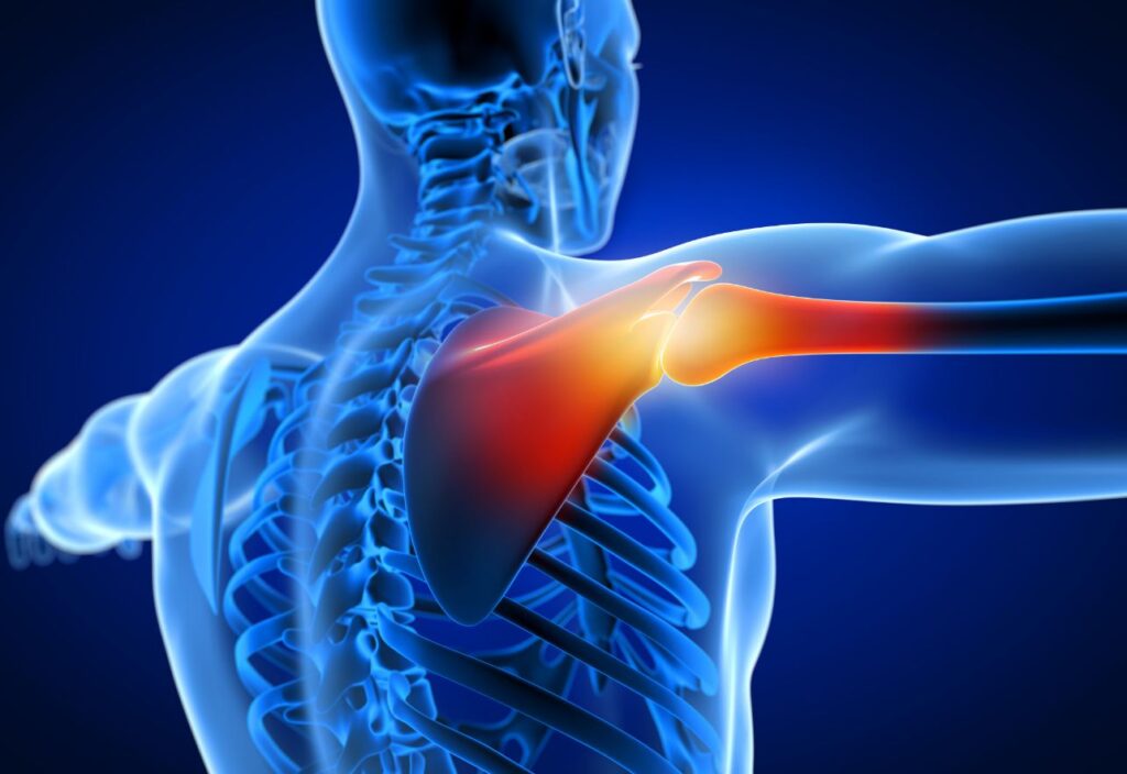 Viêm quanh khớp vai là bệnh gì? Nguyên nhân và cách điều trị bệnh