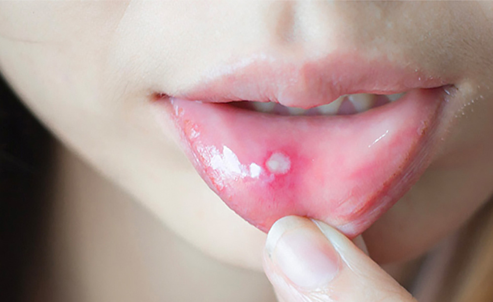 Phân loại thuốc bôi nhiệt miệng và một vài lưu ý khi sử dụng