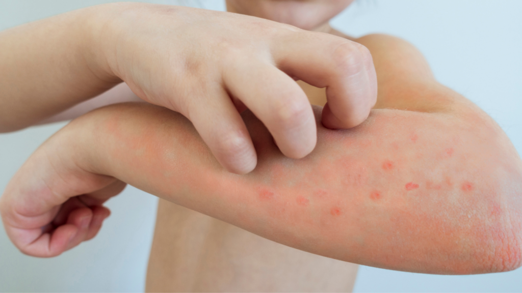 Nổi mụn nước và ngứa ngáy là triệu chứng điển hình của thủy đậu 