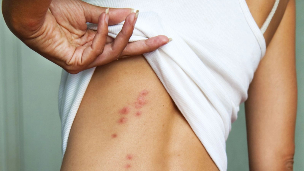 Thủy đậu ở người lớn có nguy hiểm không? Cách chẩn đoán, điều trị