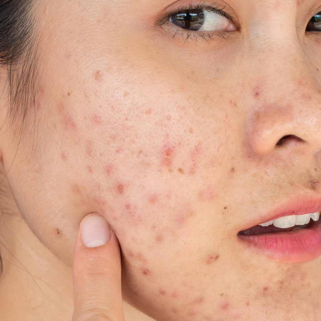 Mụn trứng cá: Nguyên nhân, cách điều trị hiệu quả