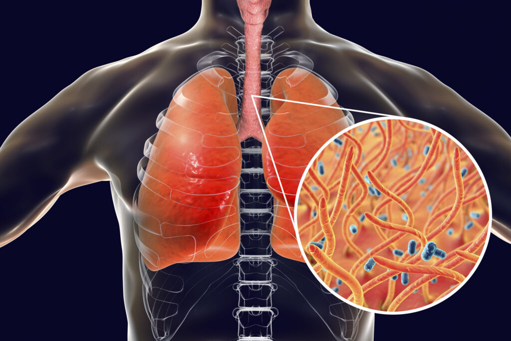 Ho gà là gì? Nguyên nhân, các triệu chứng và cách điều trị hiệu quả 