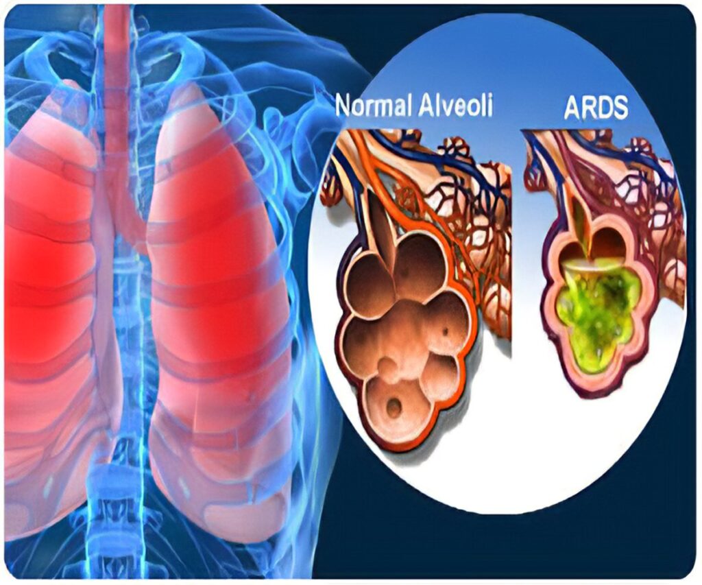 Suy hô hấp: Nguyên nhân, triệu chứng, chẩn đoán & điều trị 