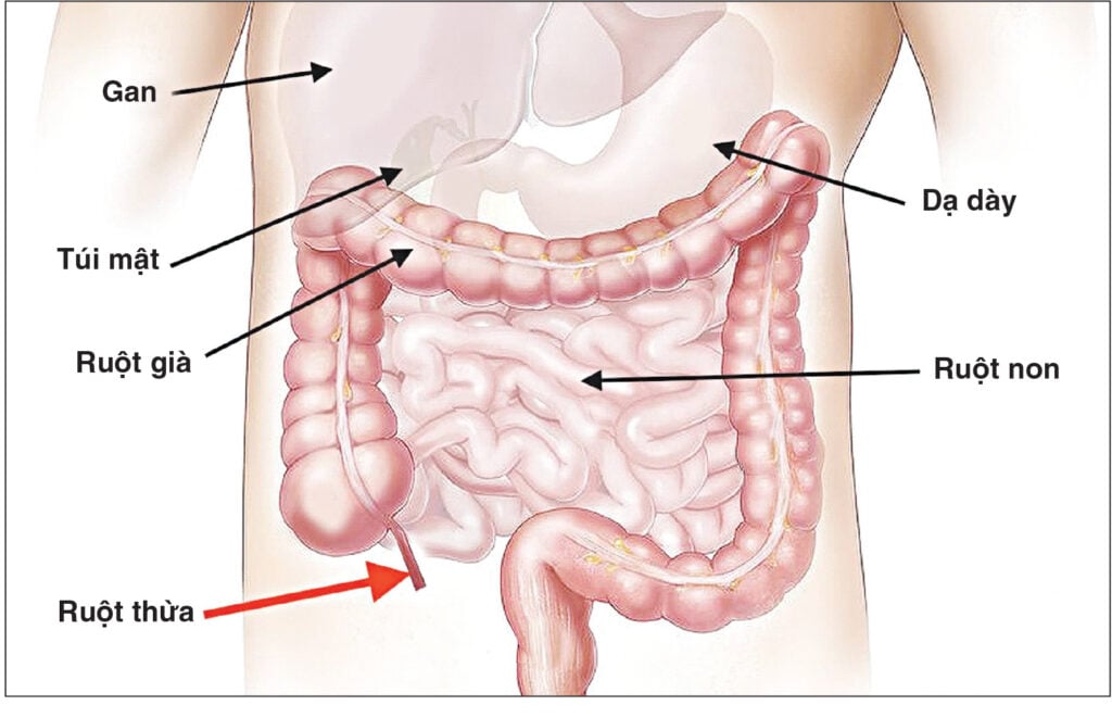 Viêm ruột thừa
