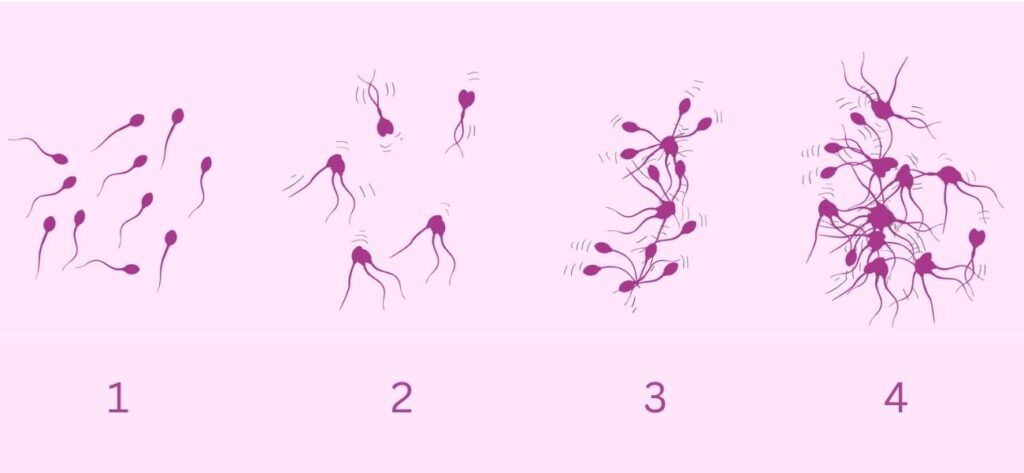 Tinh trùng vón cục: Nguyên nhân & Các biện pháp điều trị