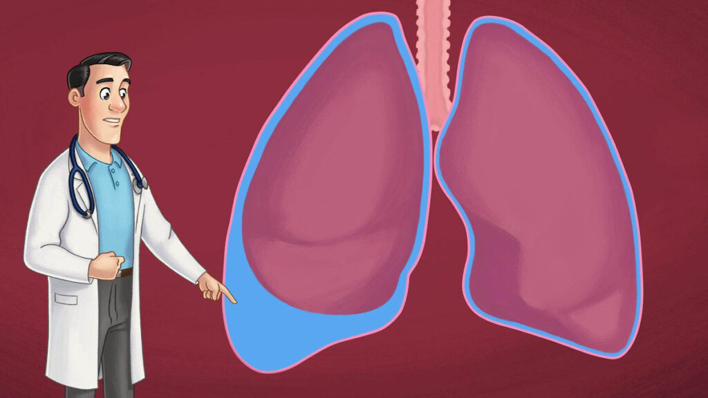 Tràn dịch màng phổi: Nguyên nhân, triệu chứng và cách điều trị
