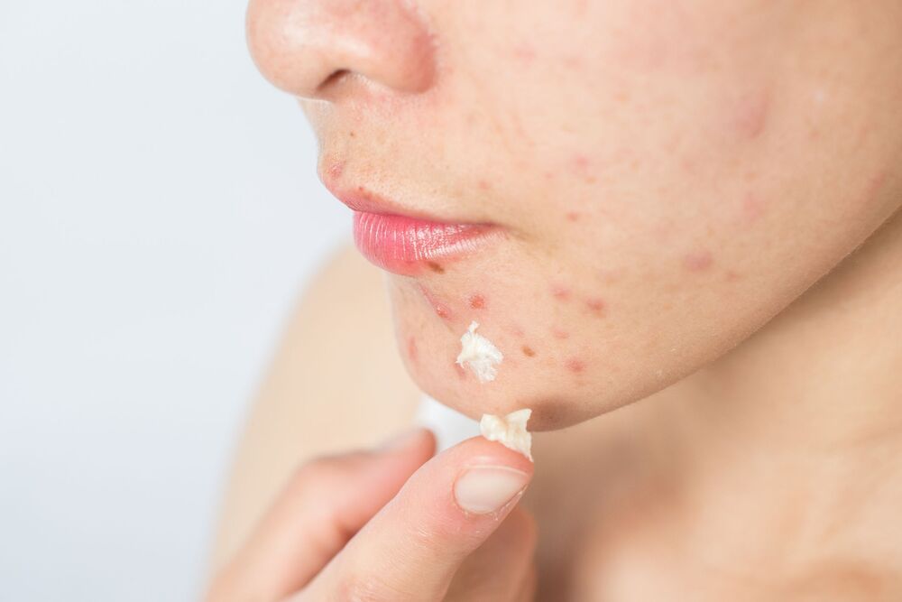 Tretinoin là thuốc gì? Công dụng điều trị mụn trứng cá
