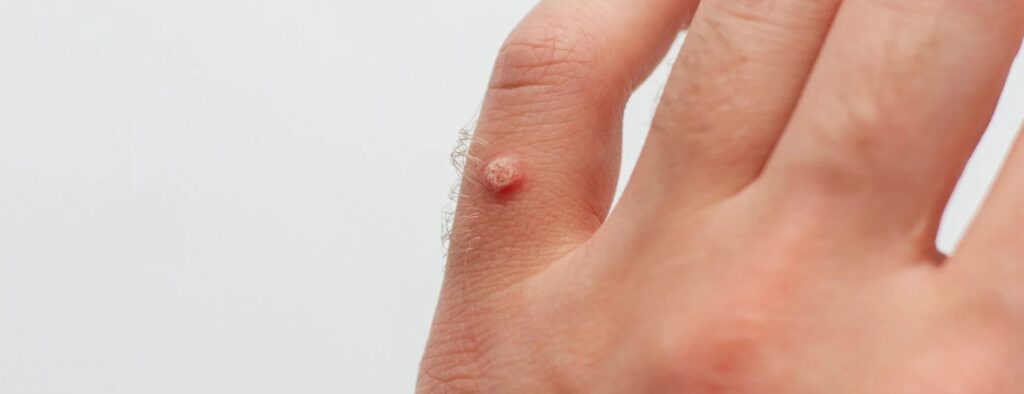 Đắp trực tiếp bột quả ấu lên vùng bị mụn để giảm sưng viêm 