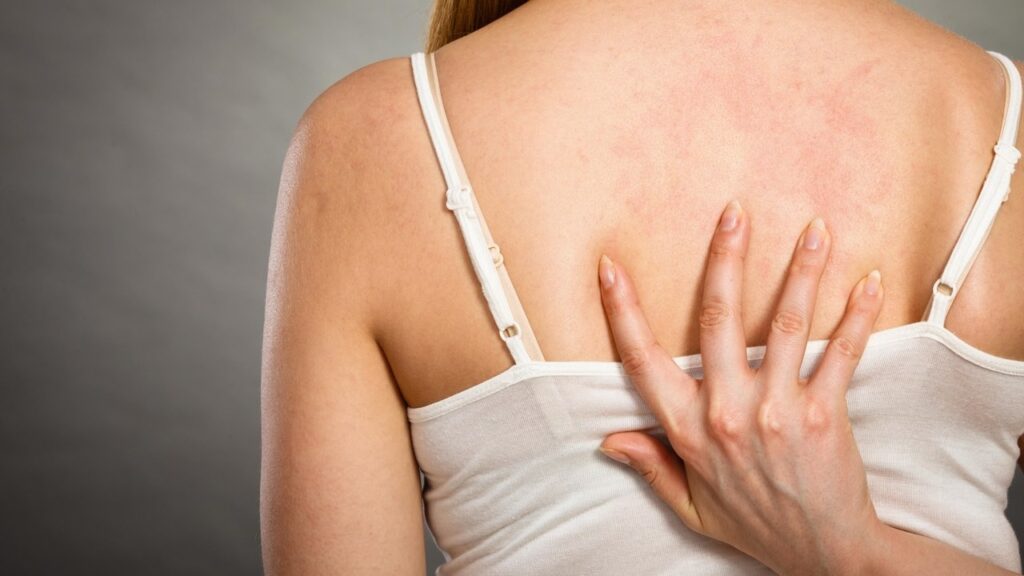 Mụn lưng: Nguyên nhân và cách khắc phục đơn giản