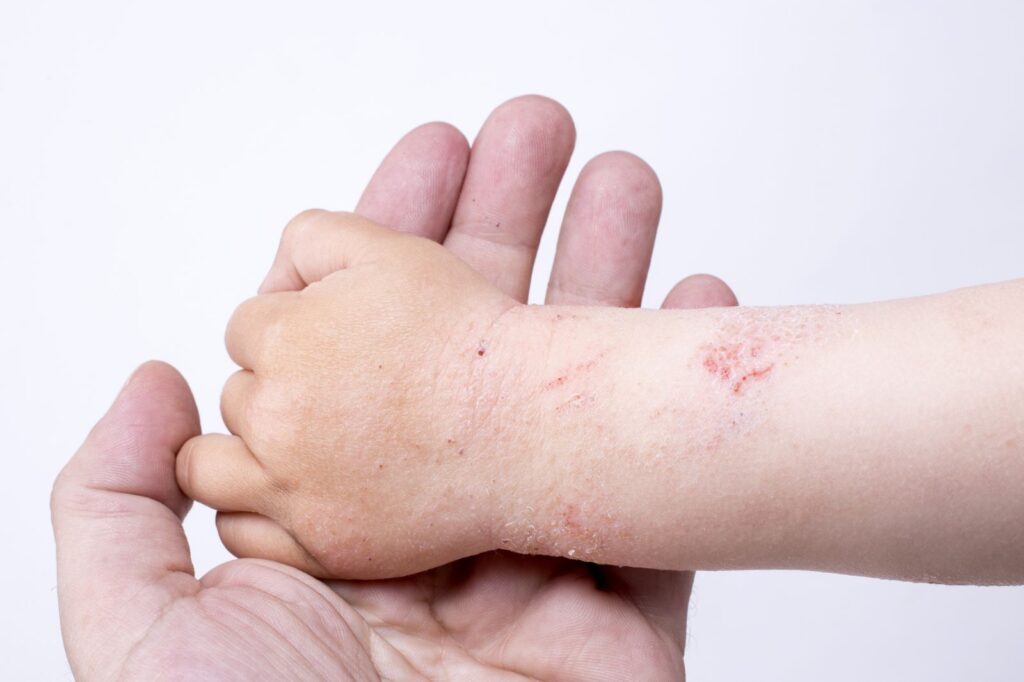 Triệu chứng ngứa và đỏ da 