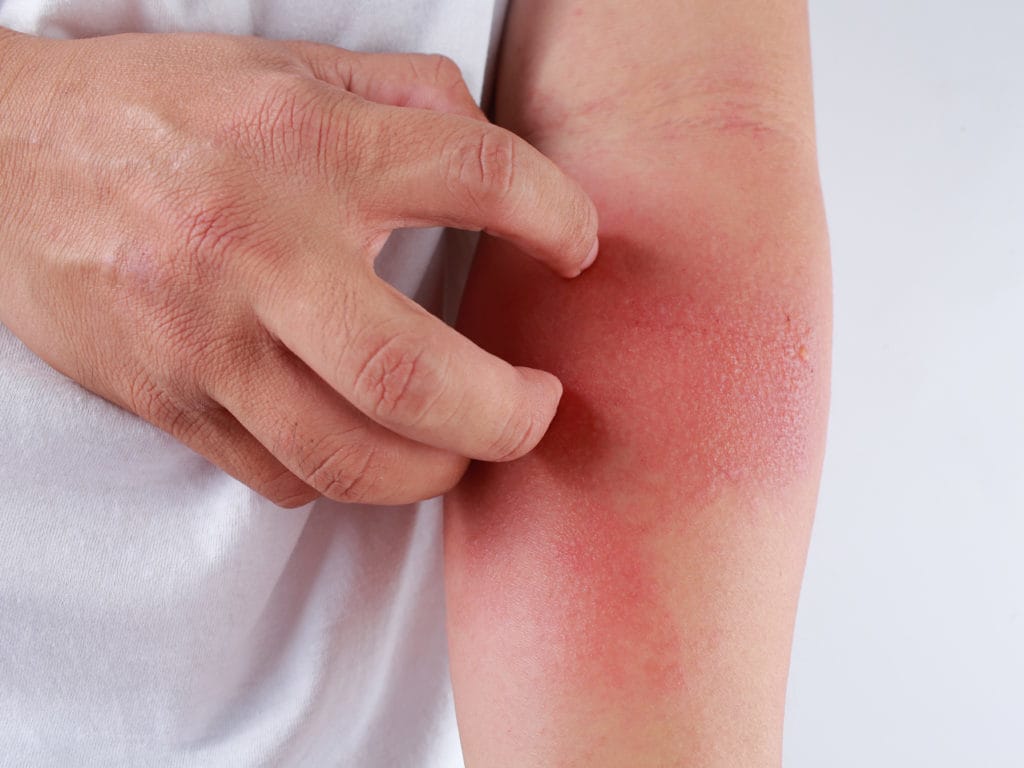 Dị ứng thời tiết khiến da trở nên đỏ và ngứa