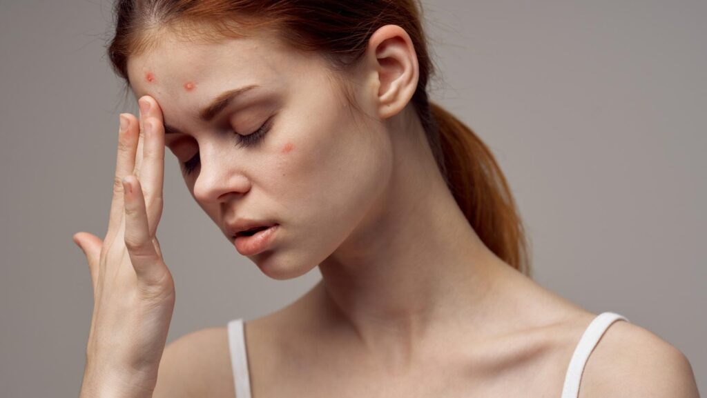 Bị nổi mụn trong chu kỳ kinh 