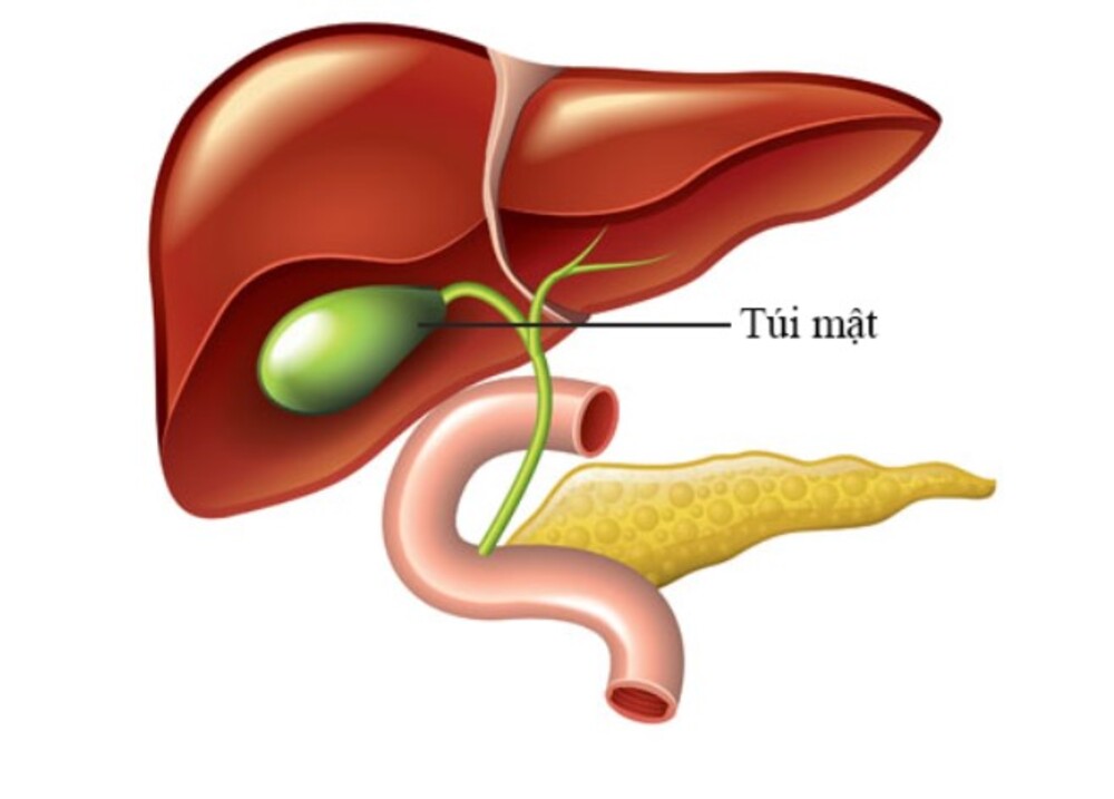 Nguyên nhân sỏi túi mật, triệu chứng và cách điều trị