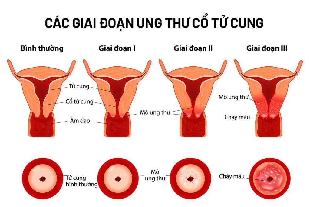 5+ Dấu hiệu ung thư cổ tử cung thường gặp