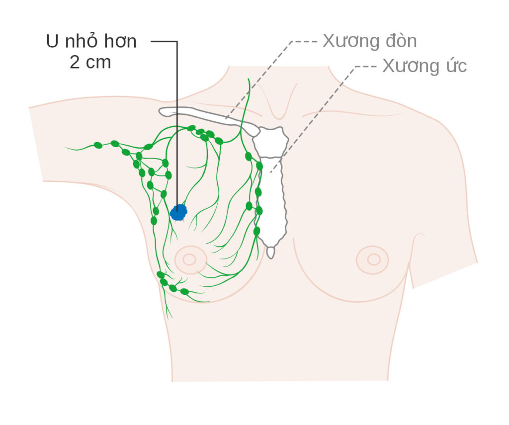 Dấu hiệu cảnh báo ung thư vú, cách kiểm tra và phòng ngừa