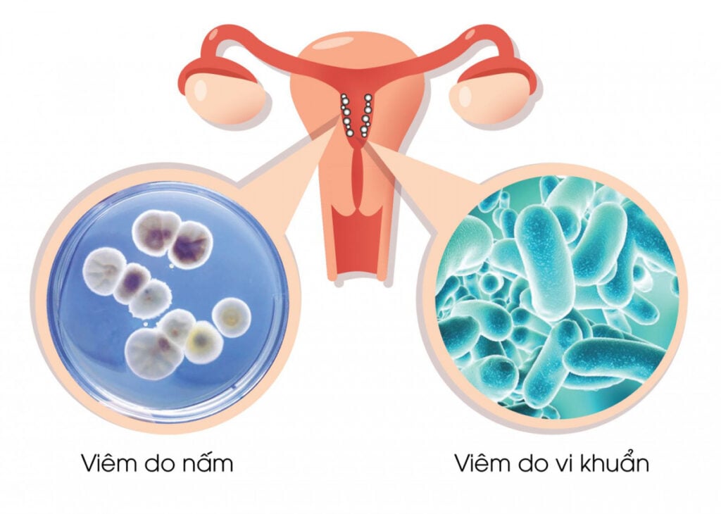 Viêm âm đạo do các loại tạp khuẩn, vi khuẩn,...gây ra 
