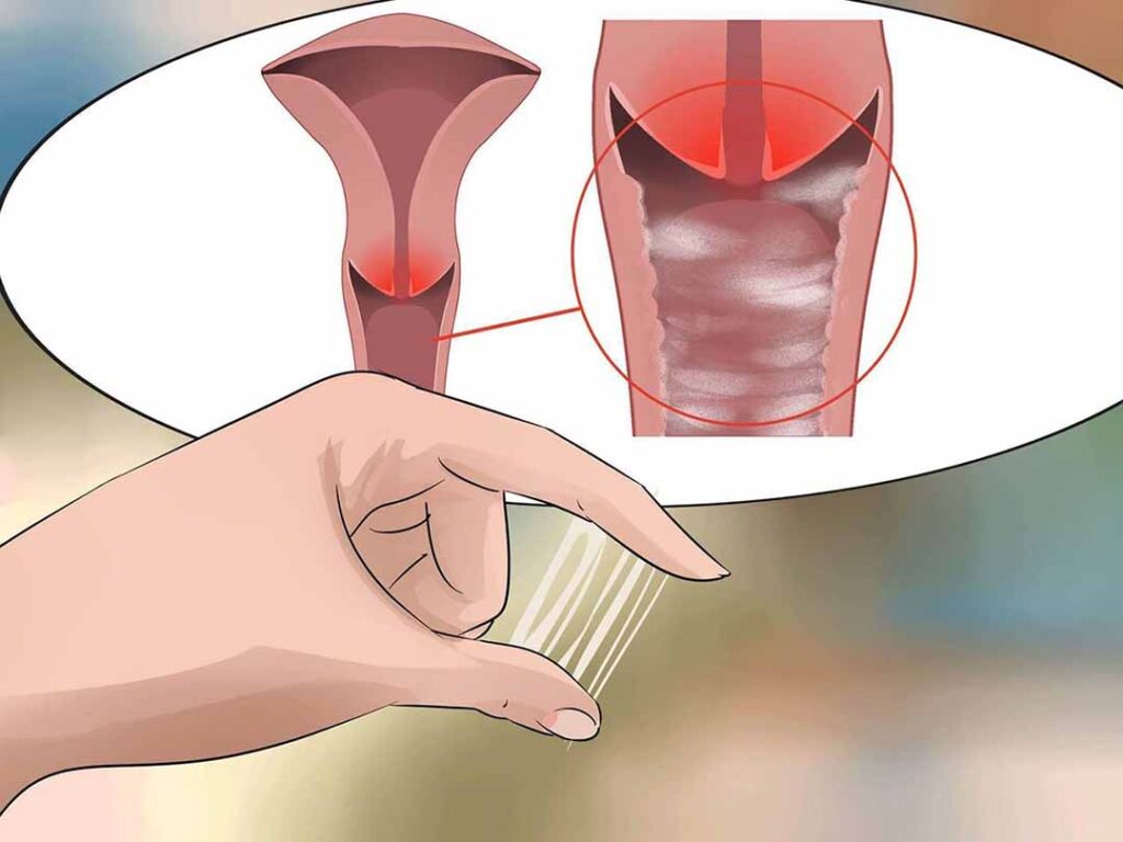 Viêm âm đạo gây ngứa rát vùng âm đạo 