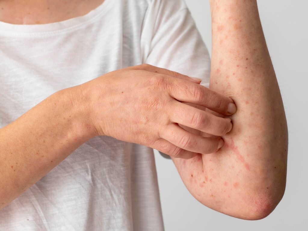 Cơ địa dễ bị dị ứng ngoài da 