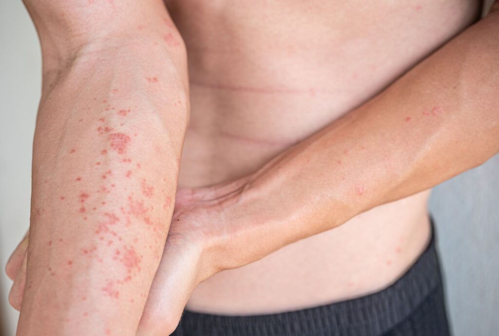 Bệnh viêm da tiếp xúc bội nhiễm 