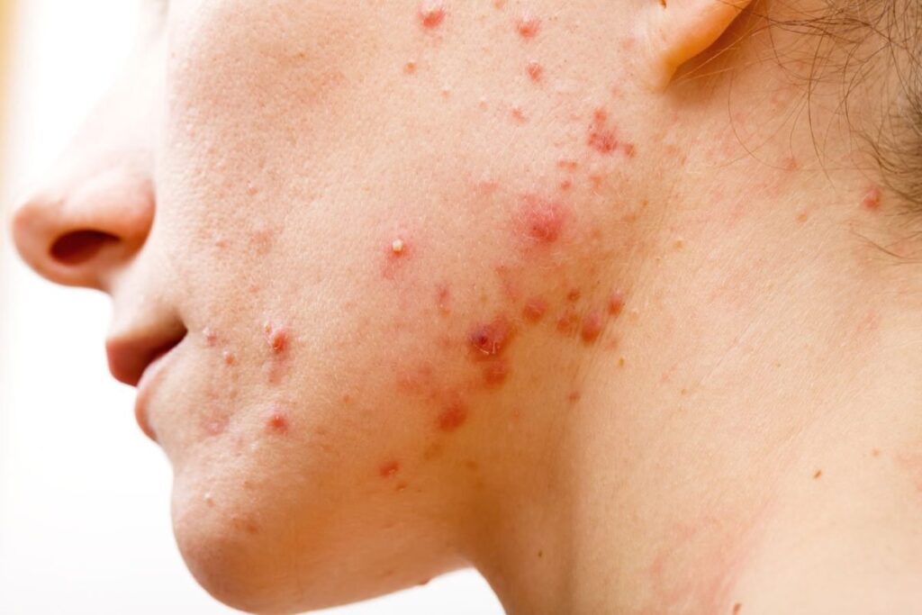 Viêm da tiết bã: Nguyên nhân, triệu chứng, cách điều trị