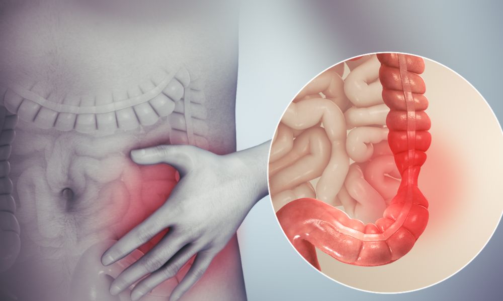 Viêm đại tràng co thắt: Biểu hiện, nguyên nhân và cách điều trị