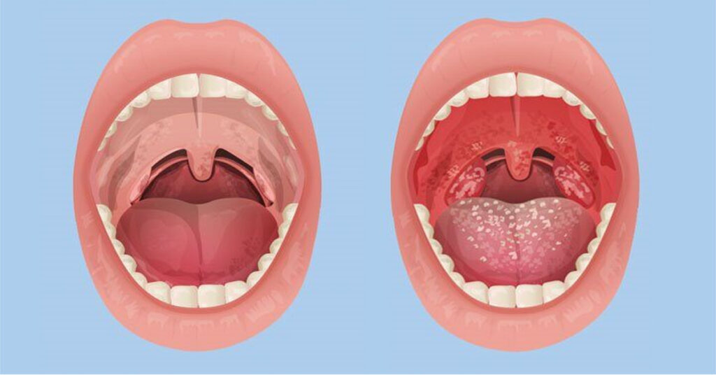 Viêm họng hạt: Nguyên nhân, dấu hiệu, cách điều trị hiệu quả