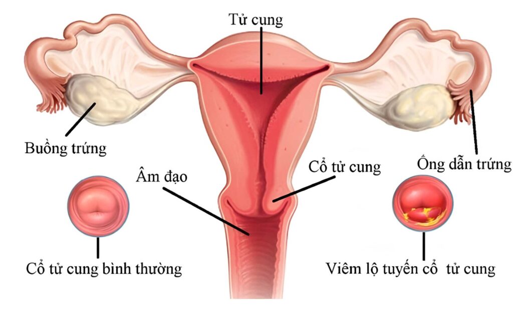 Viêm lộ tuyến: Nguyên nhân, dấu hiệu, chẩn đoán và phòng ngừa