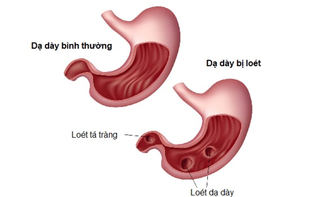Bệnh viêm loét dạ dày: Dấu hiệu, nguyên nhân, cách điều trị