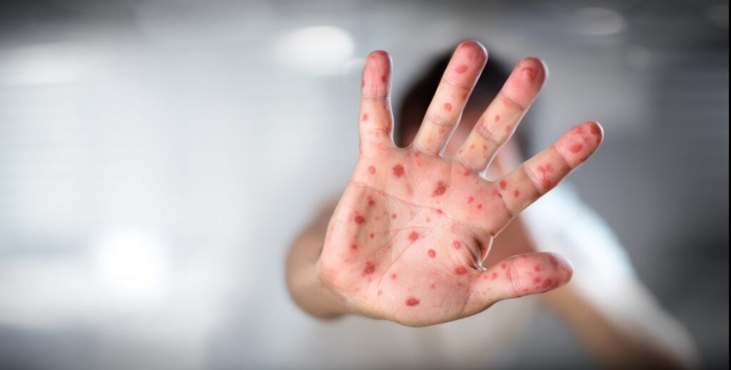Viêm mao mạch dị ứng: Triệu chứng và cách điều trị hiệu quả