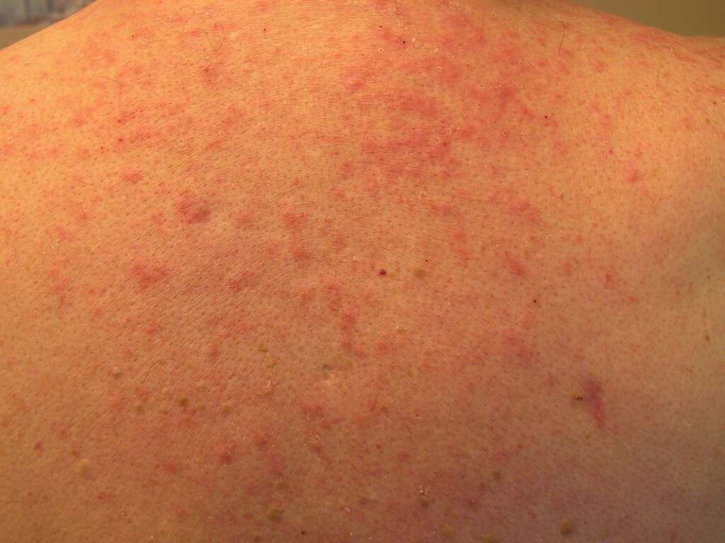 Viêm da mủ là gì? Có nguy hiểm không? Dấu hiệu, cách điều trị