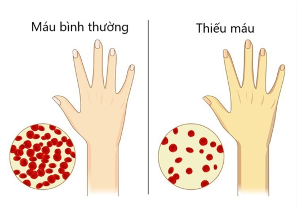 Các biểu hiện khi thiếu vitamin B12